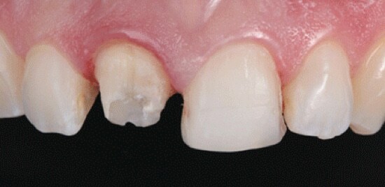 A close-up of teeth with a damaged tooth.
