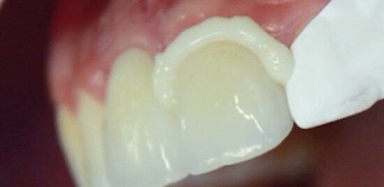 A video still of a gloved finger wiping dental cement off of a dental crown.
